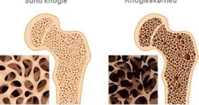 osteoporose1.jpg